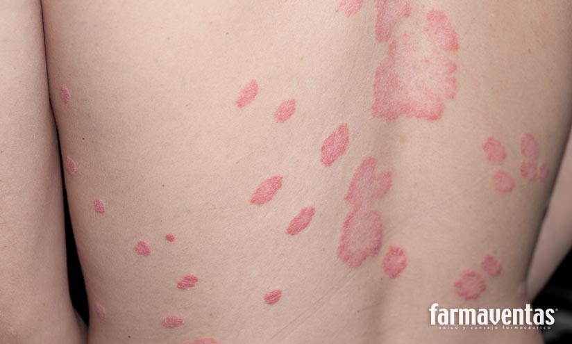 Expertos en dermatología se reúnen para debatir los avances en el manejo de enfermedades como la Psoriasis o la Dermatitis Atópica